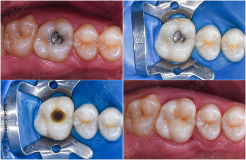 Bild auf Leinwand amalgam filling safe repacment with light cure esthetic composite filling