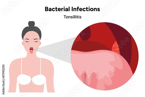 Bacterial infection tonsillitis 