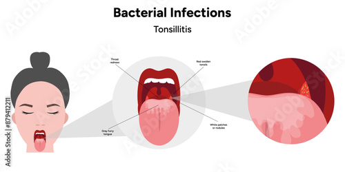 Bacterial infection tonsillitis 