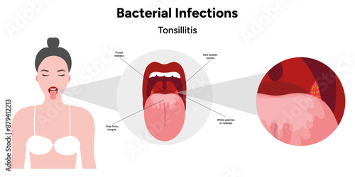Bacterial infection tonsillitis 
