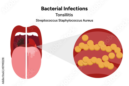 Bacterial infection tonsillitis 