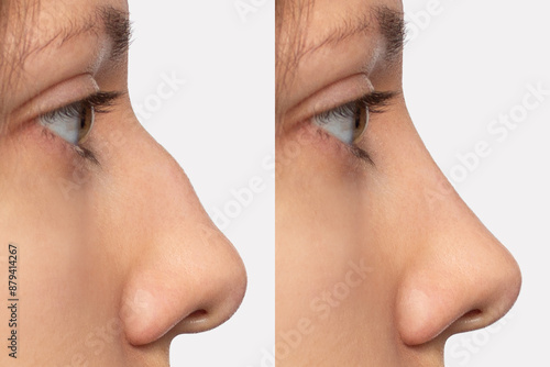 Collage before and after plastic surgery on the nose, isolated on a white background. Woman's face in profile. Correction of the nasal septum, rhinoplasty, septoplasty. Straightening the hump photo