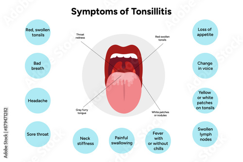 Symptoms of tonsillitis 