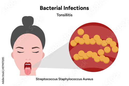 Bacterial infection tonsillitis 