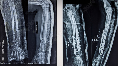 Photos X ray image of forearm showing radius ulna fracture and repair with dynamic plat