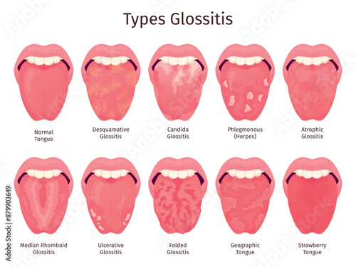 Glossitis. Scarlet tongue disease types, human mouth sore teeth problem healthy or sick xerostomia thrush atrophic candidiasis bacteria infections ulcera swanky illustration