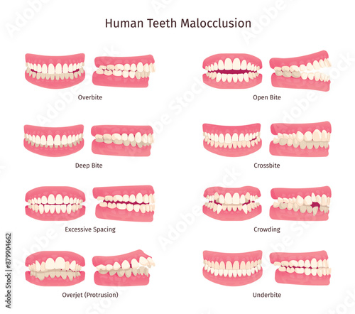 Malocclusion. Tooth open bite protruding mouth jaw problem orthodontics infographic, overbite underbite human teeth anatomy dental structure, dentistry swanky illustration