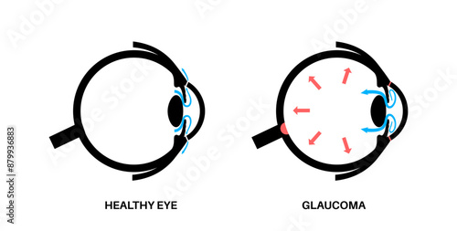 Glaucoma eye pressure