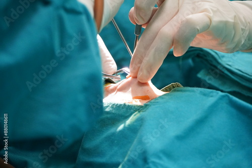 Surgeon performs open nose surgery to pull out the silicone