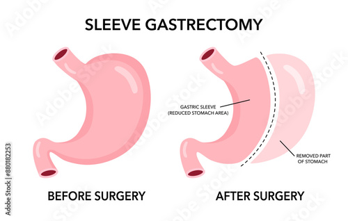 Vertical sleeve gastrectomy surgery medical vector illustration.