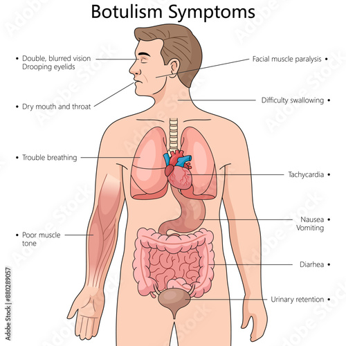 symptoms of botulism including vision issues, muscle paralysis, difficulty swallowing, respiratory problems diagram hand drawn schematic vector illustration. Medical science educational illustration