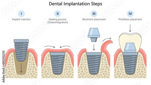 steps of dental implantation, implant insertion, healing process, abutment placement, prosthesis placement diagram hand drawn schematic vector illustration. Medical science educational illustration