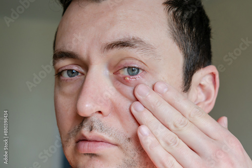 Infected chalazion (stye, barley) or hordeolum eye on lower eyelid of man photo