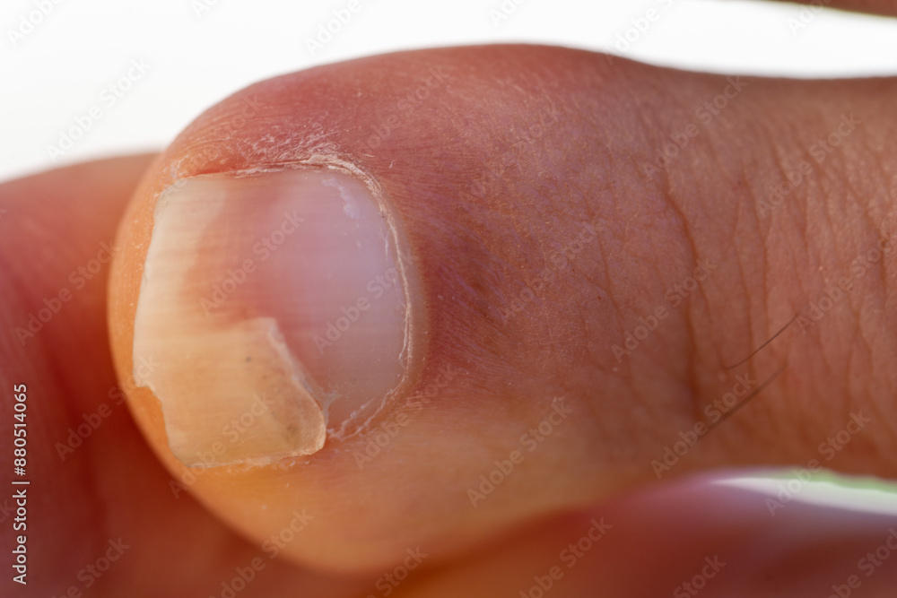 Set of toes where one of the nails is broken. Set of toes where one of the nails is broken.