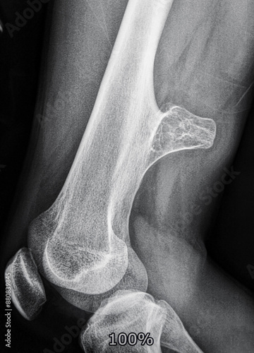 Fotografia Xray image of a osteochondroma, a benign bone tumour