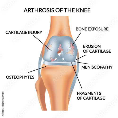 Knee arthrosis. Unhealthy knee structure. Bone exposure, damaged knee structure comparison. Medical poster with foot bones. Isolated vector illustration