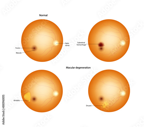 Normal retina and Macular degeneration: Drusen, Atrophy, Subretinal hemorrhage. 