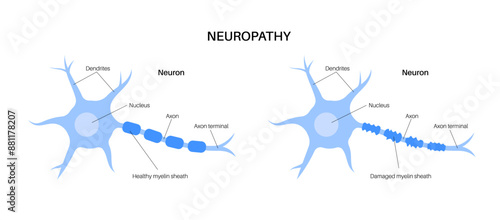 Peripheral neuropathy medical poster