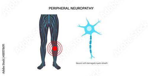 Peripheral neuropathy medical poster