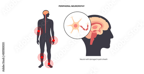 Peripheral neuropathy medical poster