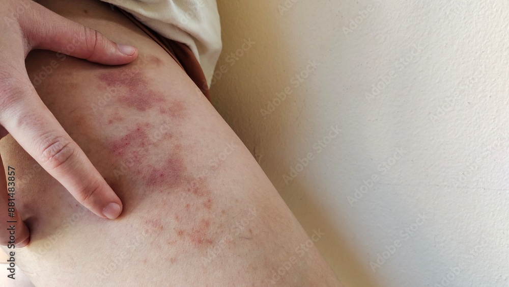 close up of a patient, rash hives allergy and inflammation skin, reaction and urticaria, scar and disease on the leg of the woman, health care and medical concept. close up of a patient, rash hives allergy and inflammation skin, reaction and urticaria, scar and disease on the leg of the woman, health care and medical concept.