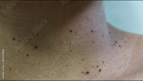 Close up the skin tags on woman's neck. Acrochordon. Health care concept. Woman showing her neck's skin with skin tag. photo