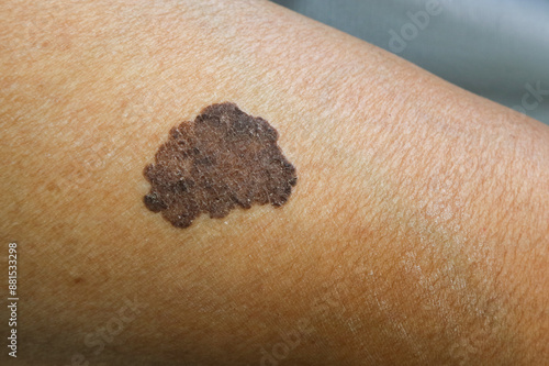 melanoma - a malignant tumor of the skin