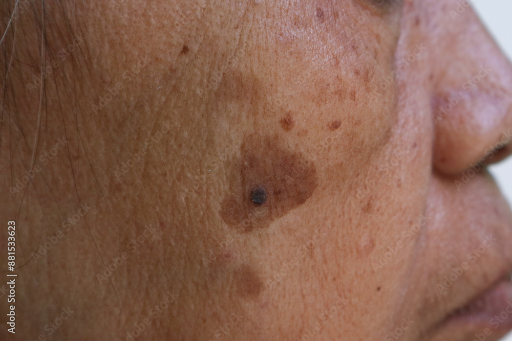 Fototapeta premium Age spots with lentigo maligna, eye bags and smile line on the old woman's cheek. an early form of pre-invasive melanoma in which cancer cells are confined to the top layer of the skin.