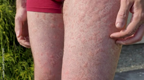 Itchy hives spreading across legs