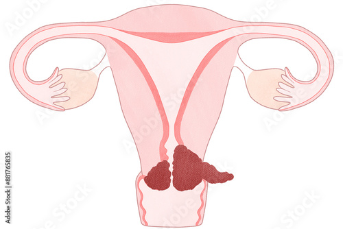 Blank cervical cancer stage 2B diagram PNG
