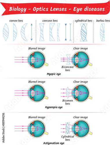 Optical lenses and eye diseases for science and biology.