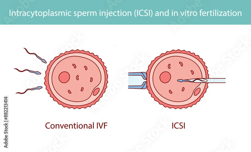 Intracytoplasmic sperm injection (ICSI) and in vitro fertilization hand drawn in line style