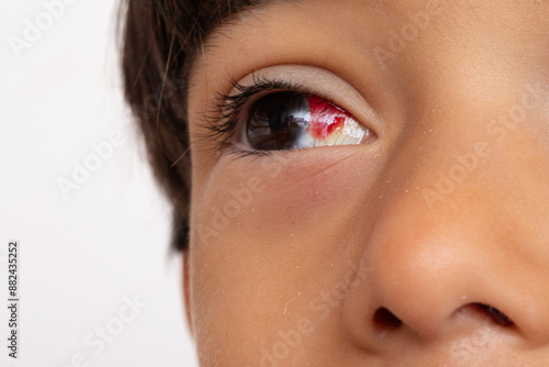 Young boy suffering from subconjunctival hemorrhage in eye photo