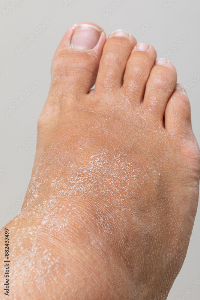 Fototapeta premium Dry skin showing signs of severe dehydration on foot