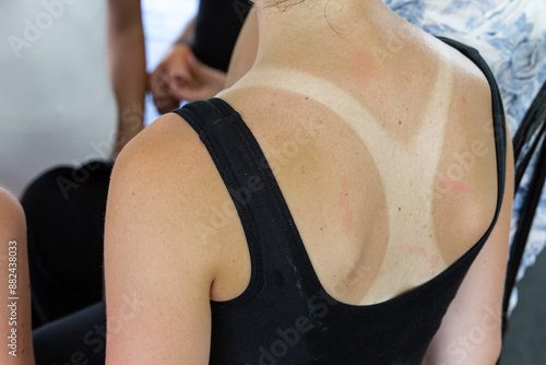 Young woman showing sunburn marks on her back from tank top