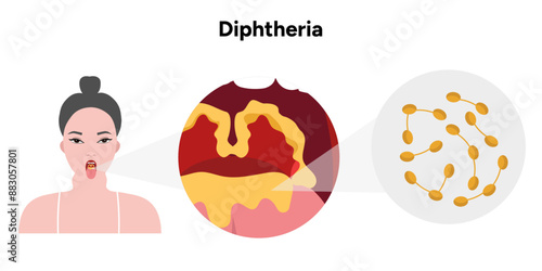 Diphtheria medical illustration with woman throat zoom and bacterial 