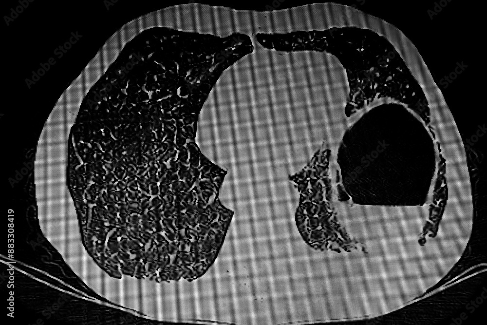 Medical themes: Tumor in the distal esophagus with left pneumoperitoneum