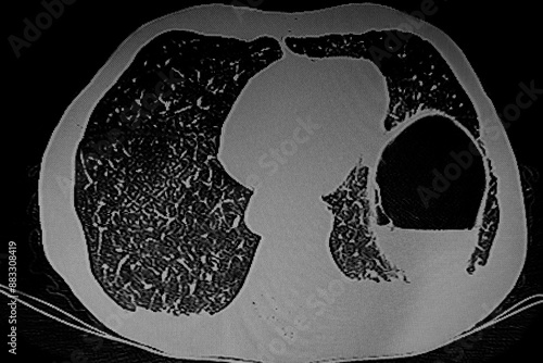 Obraz na płótnie Medical themes: Tumor in the distal esophagus with left pneumoperitoneum w salonie