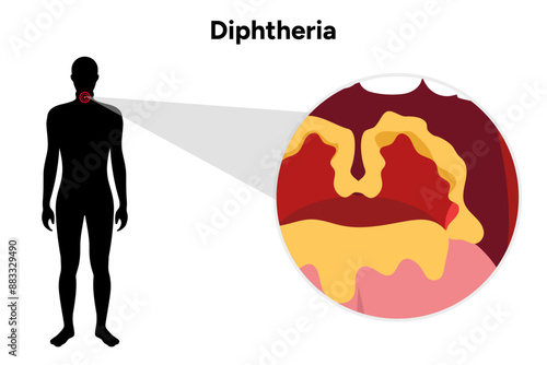 Diphtheria medical information with human illustration and throat zoom 