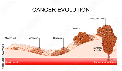 Cancer evolution. Mutated cell, Hyperplasia, Dysplasia, Malignant tumor.