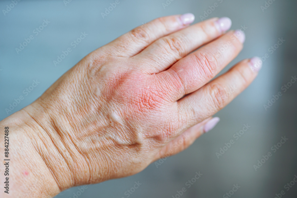 Fototapeta premium hand swollen from wasp sting