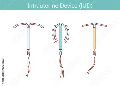 Intrauterine device or IUD.  intrauterine contraceptive device.  Vector illustration