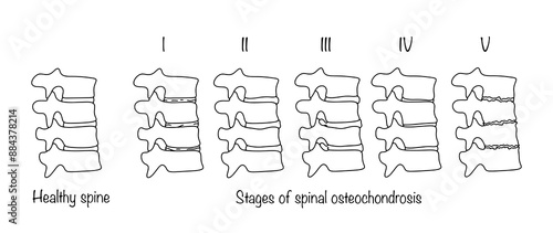 Osteochondrosis