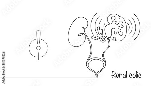 Renal colic