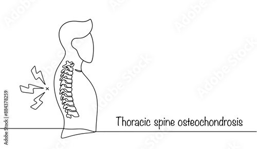 Thoracic spine osteochondrosis