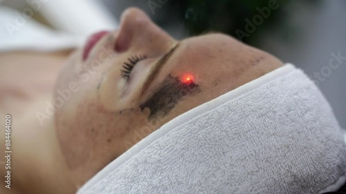 A beauty spa offers a laser facial treatment. Light. A woman undergoes a rejuvenating peel with a carbon mask, promoting skincare and reducing pigmented lesions. Female face cosmetic