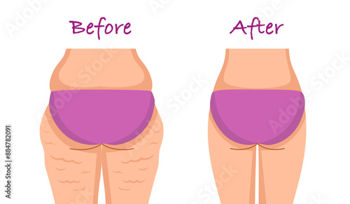 Fat and slim woman butt with signs before after. Female shape after weight loss.