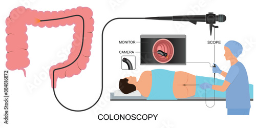 Colonoscopy is a procedure to look inside the colon.