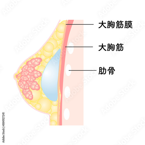 バッグ豊胸_乳腺下法