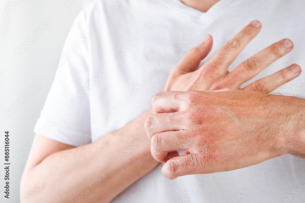 Man scratches or shows hands with dry, cracked skin on white backgrounds. Problem with many people - eczema on hand, allergies or dry skin. Health care concept. Close up. Man scratches or shows hands with dry, cracked skin on white backgrounds. Problem with many people - eczema on hand, allergies or dry skin. Health care concept. Close up.